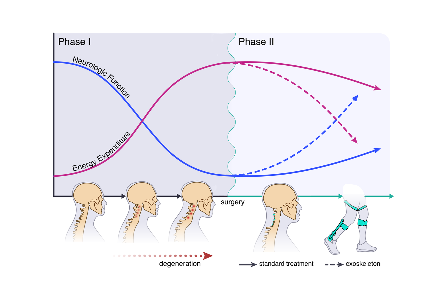 kyphosis medical graphic